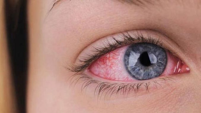 Simptomi povišenog očnog pritiska- koje tegobe ne treba ignorisati?